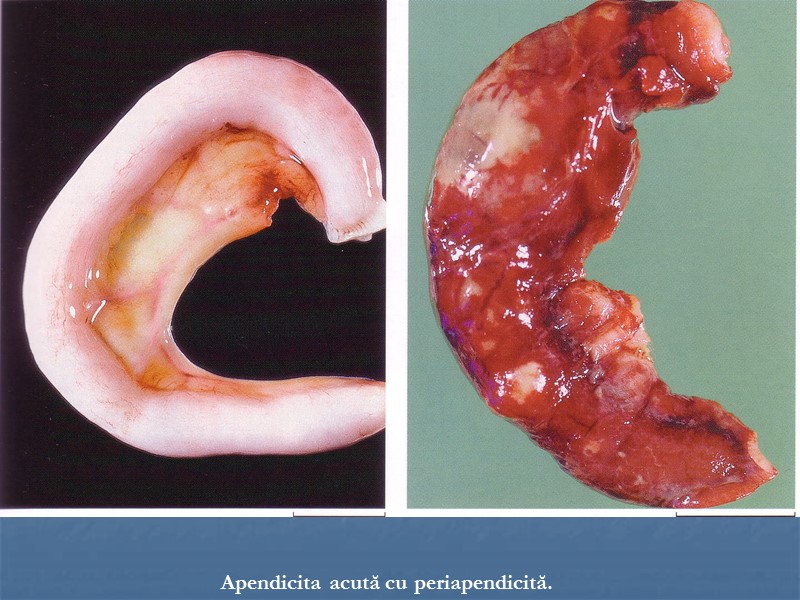 Apendicita acută cu periapendicită.